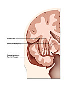 Haemorrhagic Stroke Locations, Illustration