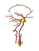 Common Blocked Arteries, Illustration
