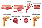 Bone Metastase, Illustration