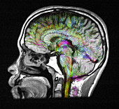 Normal Brain, Fibre Tractography and MRI