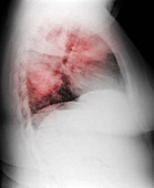 Atypical Pneumonia in Smoker, X-ray