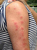 Bed Bug Bites on Arm