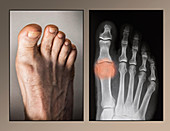 Osteoarthritis Of Big Toe