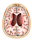 Neuronal Ceroid-Lipofuscinosis