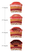 Burn Severity, Illustration