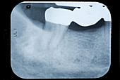 Periapical X-Ray Showing an Abscess