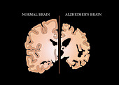 Alzheimer's and Normal Brains, Comparison