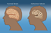 Alzheimer's and Normal Brains, Comparison