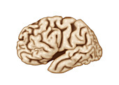 Brain Affected by Alzheimer's Disease