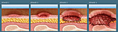 Progression of Pressure Sore