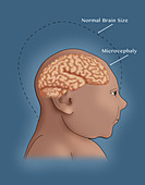 Microcephaly, Illustration