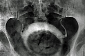 Prostatic adenoma, X-ray