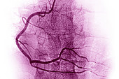 Coronary artery, Angiograph