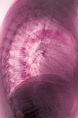 Calcific aortic arch atheroma, X-ray