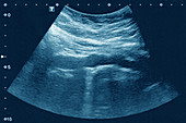 Calcific aortic atheroma, ultrasound
