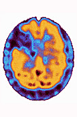 Stroke, brain scintigraphy