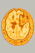 Stroke, brain scintigraphy