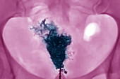 Uterine cancer, X-ray