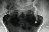 Renal colic, X-ray