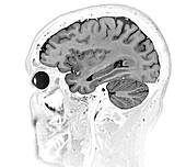 Normal Brain, MRI