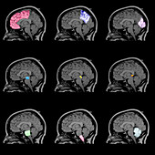 Composite MRI Showing Brain Regions