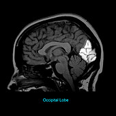 Occipital Lobe, Sagittal MRI