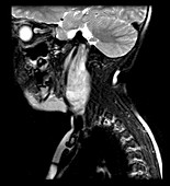 Neuroblastoma of Neck in Child, MRI