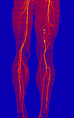 Atherosclerosis, CT angiogram