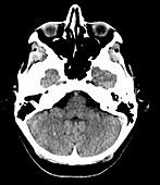 Large Developmental Venous Anomaly, CT scan