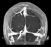 Large Developmental Venous Anomaly, MRI