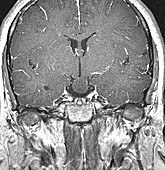 Hypothalamic Hamartoma, MRI