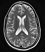 Parietal Lobe AVM, MRI