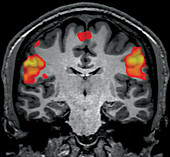 fMRI during Facial Grimacing