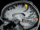 fMRI during Foot Movement