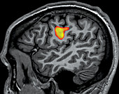 fMRI during Tongue Movement