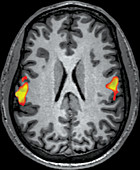 fMRI during Tongue Movement