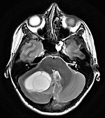 Cerebellar Hemangioblastoma, MRI