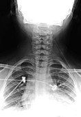 Pencil in Child's Neck, X-ray