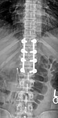 Spinal Instrumentation for Fracture, X-ray