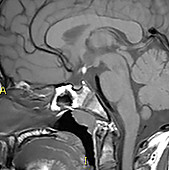 Small Pituitary and Ectopic Neurohypophysis, MRI