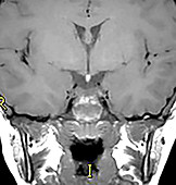 Small Pituitary and Ectopic Neurohypophysis, MRI