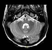 Large Vestibular Aqueduct, Hearing Loss, MRI