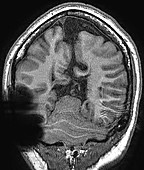 Rhomboencephalosynapsis, MRI