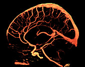 Normal Cerebral Vasculature, 3D CT Angiogram
