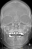CT X-ray of Dental Work