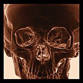 Neurofibromatosis type I, 3D CT scan