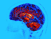 Normal Brain, SWI MRI