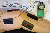 Transcutaneous electric nerve stimulation (TENS)