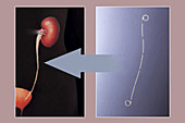 Ureteral Stent Composite