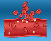 Blood clot